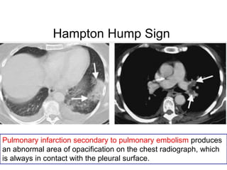 Hampton Hump Sign
Pulmonary infarction secondary to pulmonary embolism produces
an abnormal area of opacification on the chest radiograph, which
is always in contact with the pleural surface.
 