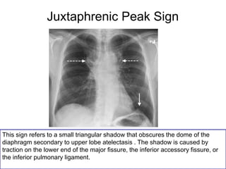 Juxtaphrenic Peak Sign
This sign refers to a small triangular shadow that obscures the dome of the
diaphragm secondary to upper lobe atelectasis . The shadow is caused by
traction on the lower end of the major fissure, the inferior accessory fissure, or
the inferior pulmonary ligament.
 