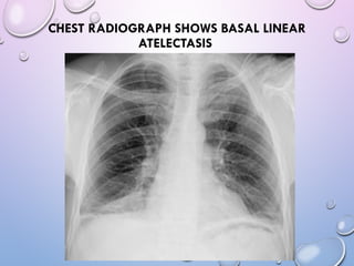 Abnormal signs on a Chest X-Ray (Plain Radiograph) | PPT