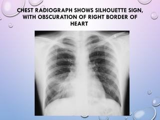 Abnormal signs on a Chest X-Ray (Plain Radiograph) | PPT