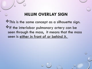 Hilom Sign Abnormal signs on a Chest X-Ray (Plain Radiograph) | PPT