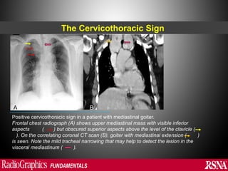 Abnormal signs on a Chest X-Ray (Plain Radiograph) | PPT