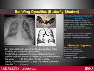 Abnormal signs on a Chest X-Ray (Plain Radiograph) | PPT