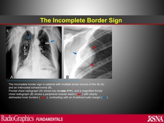 Abnormal signs on a Chest X-Ray (Plain Radiograph) | PPT