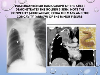 Abnormal signs on a Chest X-Ray (Plain Radiograph) | PPT