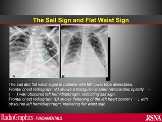 Sail Sign Abnormal signs on a Chest X-Ray (Plain Radiograph) | PPT