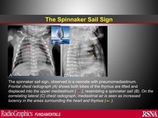 Abnormal signs on a Chest X-Ray (Plain Radiograph) | PPT