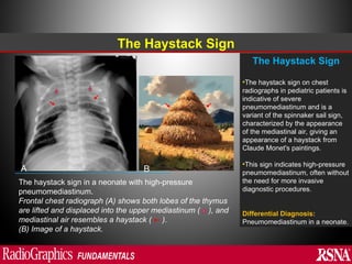 Abnormal signs on a Chest X-Ray (Plain Radiograph) | PPT