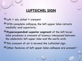 Luftcycle Sign Abnormal signs on a Chest X-Ray (Plain Radiograph) | PPT