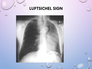 Luftcycle Sign Abnormal signs on a Chest X-Ray (Plain Radiograph) | PPT