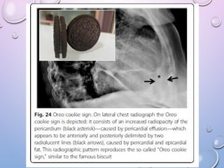 Abnormal signs on a Chest X-Ray (Plain Radiograph) | PPT