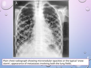 Abnormal signs on a Chest X-Ray (Plain Radiograph) | PPT