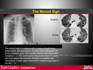 Manod Sign Abnormal signs on a Chest X-Ray (Plain Radiograph) | PPT