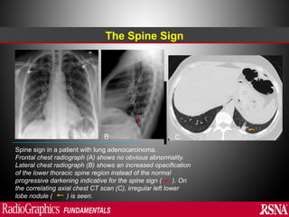 Abnormal signs on a Chest X-Ray (Plain Radiograph) | PPT