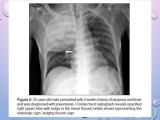 Abnormal signs on a Chest X-Ray (Plain Radiograph) | PPT