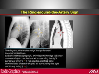 Abnormal signs on a Chest X-Ray (Plain Radiograph) | PPT