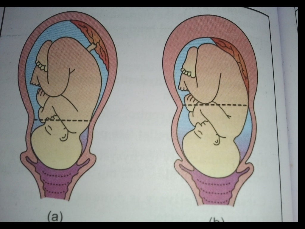 Abnormal uterine action