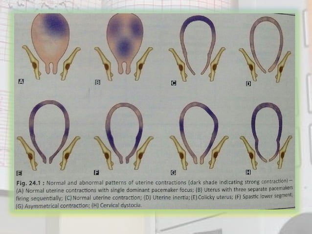 Abnormal Uterine Action Pdf – Abnormal Uterine Action – ULDWR