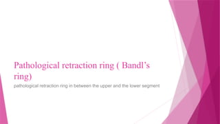 Pathologic Retraction Ring Abnormal uterine action by Dr Farhana Zahir.pptx