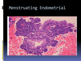 Menstruating Endometrial
 