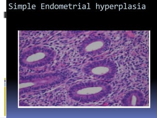 Simple Endometrial hyperplasia
 