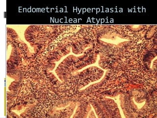 Endometrial Hyperplasia with
Nuclear Atypia
 