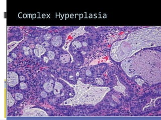 Complex Hyperplasia
 