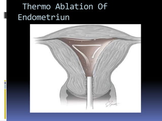 Thermo Ablation Of
Endometriun
 