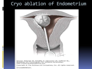 Cryo ablation of Endometrium
 