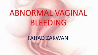 ABNORMAL VAGINAL
BLEEDING
FAHAD ZAKWAN
 