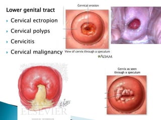 Lower genital tract
 Cervical ectropion
 Cervical polyps
 Cervicitis
 Cervical malignancy
 