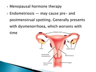  Menopausal hormone therapy
 Endometriosis — may cause pre- and
postmenstrual spotting. Generally presents
with dysmenorrhoea, which worsens with
time
 
