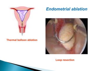 Thermal balloon ablation
Loop resection
Endometrial ablation
 