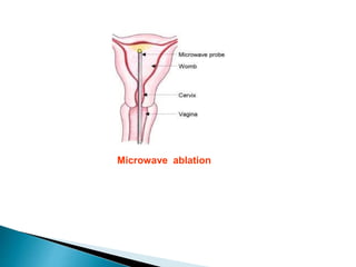 Microwave ablation
 
