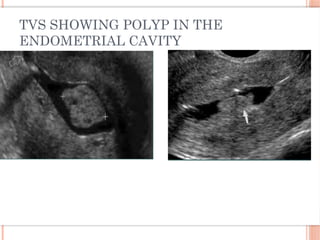 TVS SHOWING POLYP IN THE
ENDOMETRIAL CAVITY
 
