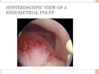 HYSTEROSCOPIC VIEW OF A
ENDOMETRIAL POLYP
 