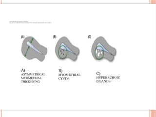 ADENOMYOSIS DIAGNOSTIC CRITERIA
GRAPHICAL REPRESENTATIONS OF EIGHT TVUS CRITERIA PROPOSED BY MUSA GROUP
A)
ASYMMETRICAL
MYOMETRIAL
THICKENING
B)
MYOMETRIAL
CYSTS
C)
HYPERECHOIC
ISLANDS
 