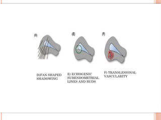 E) ECHOGENIC
SUBENDOMETRIAL
LINES AND BUDS
F) TRANSLESIONAL
VASCULARITY
D)FAN SHAPED
SHADOWING
 