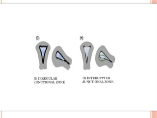 G) IRREGULAR
JUNCTIONAL ZONE
H) INTERUPPTED
JUNCTIONAL ZONE
 