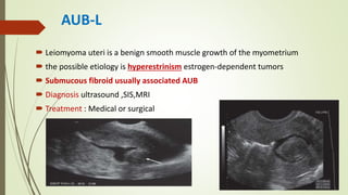 AUB-L
 Leiomyoma uteri is a benign smooth muscle growth of the myometrium
 the possible etiology is hyperestrinism estrogen-dependent tumors
 Submucous fibroid usually associated AUB
 Diagnosis ultrasound ,SIS,MRI
 Treatment : Medical or surgical
 