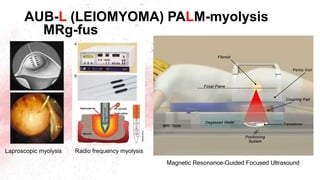 AUB-L (LEIOMYOMA) PALM-myolysis
MRg-fus
Laproscopic myolysis Radio frequency myolysis
Magnetic Resonance-Guided Focused Ultrasound
 