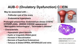 May be associated with –
- Follicular cyst of the ovary
- Endometrial hyperplasia
Prolonged amenorrhea- Endometrium shows CYSTIC
HYPERPLASIA, [SWISS CHEESE appearance]
“Metropathia hemorrhagica”, “Schroeder’s disease”
• Characteristic
- Hyperplastic gland &stroma
- Cystic or irregularly dilated gland
- Increase in Vascularization
- Necrosis of Superficial Endometrium
- Tortuous & Dilated SPIRAL ARTERIOLES and veins
AUB-O (Ovulatory Dysfunction) COEIN
 