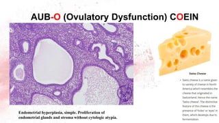 Endometrial hyperplasia, simple. Proliferation of
endometrial glands and stroma without cytologic atypia.
AUB-O (Ovulatory Dysfunction) COEIN
 