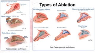 Radiofrequency ablation Plasma energy (ionized argon)
Cryotherapy
Types of Ablation
Resectoscopic techniques
Non Resectoscopic techniques
Transcervical resection
Laser ablation
Roller blade ablation
 