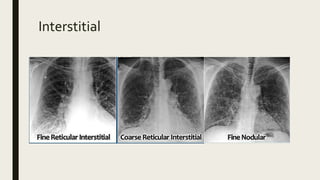 Abnormal x ray | PPTX