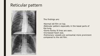 Basilar Reticular Pattern Abnormal x ray | PPTX