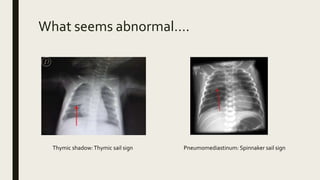 Abnormal x ray | PPTX
