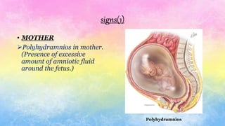 signs(1)
• MOTHER
Polyhydramnios