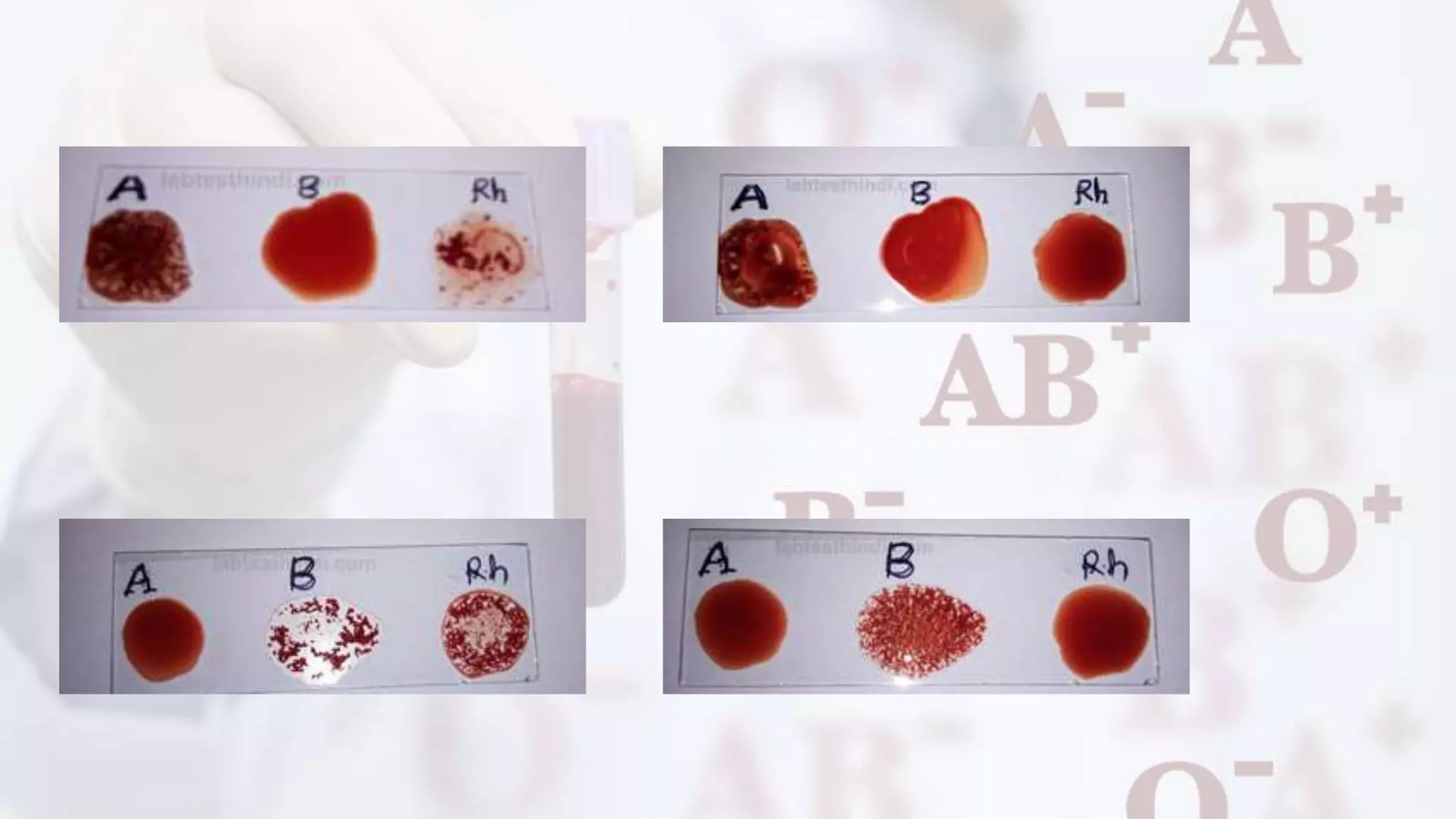 ABO blood.pptx | Blood Disorders | Diseases and Conditions