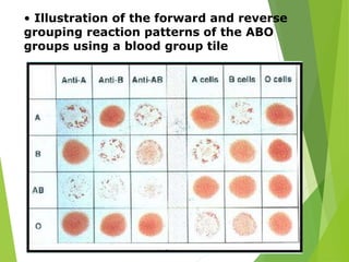 • Illustration of the forward and reverse 
grouping reaction patterns of the ABO 
groups using a blood group tile 
 